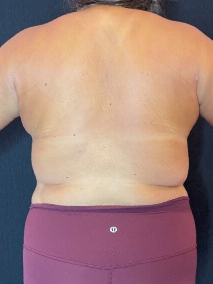 Upper Back Laser Lipo After