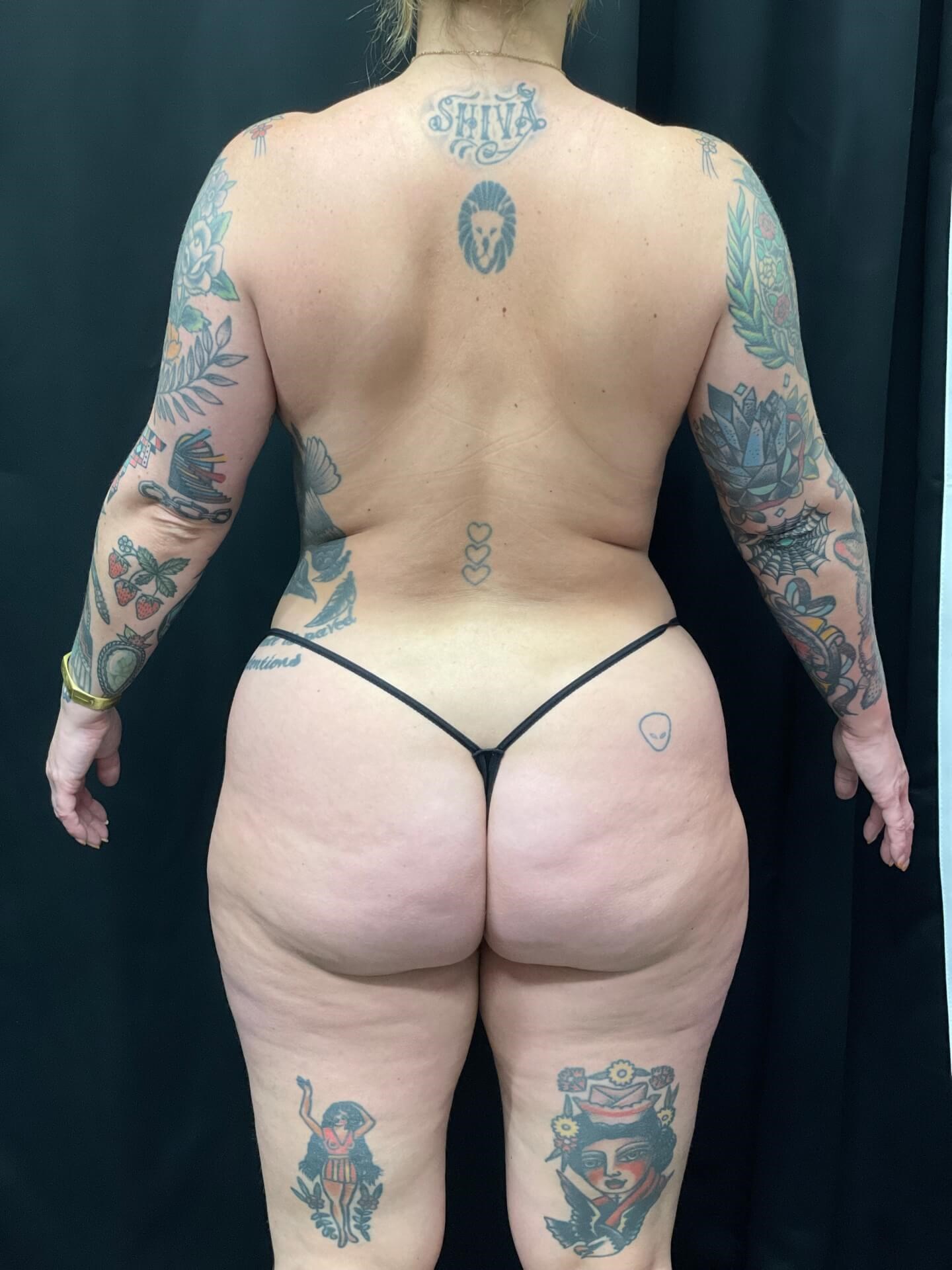 360 laser lipo back view Before