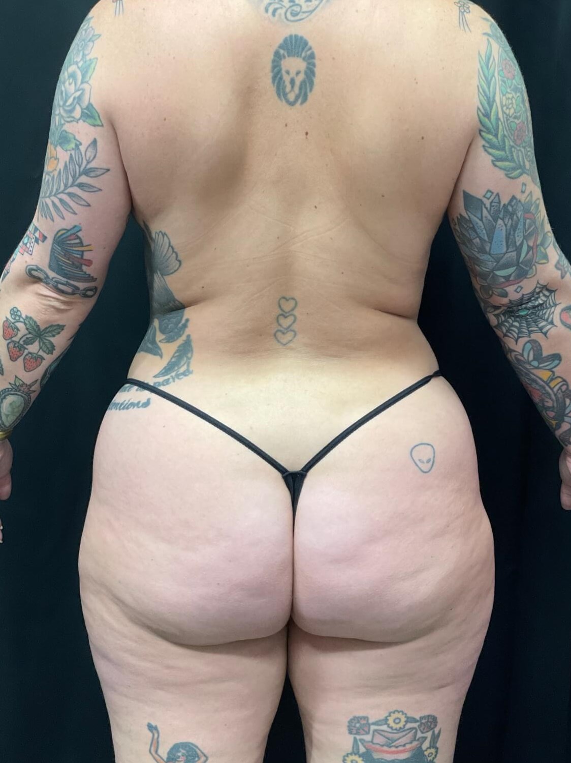 360 laser lipo back view Before