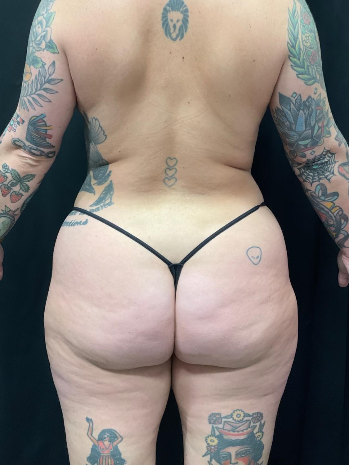 back view of 360 laser lipo Before