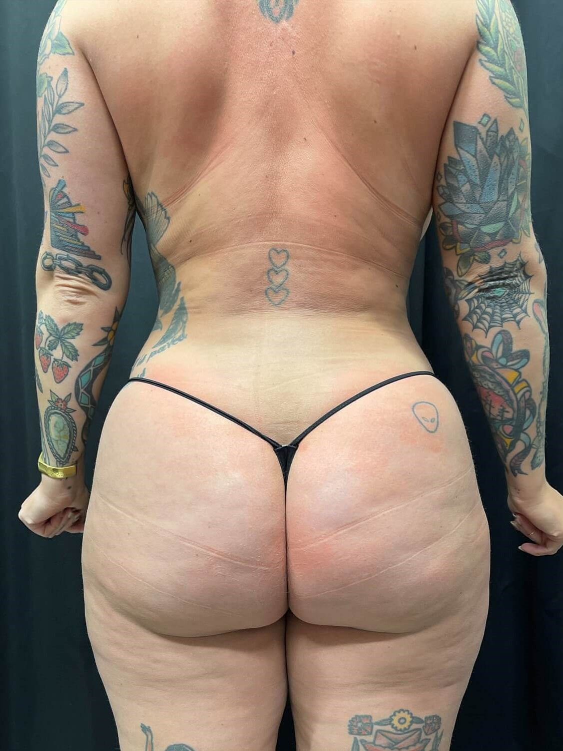 back view of 360 laser lipo After