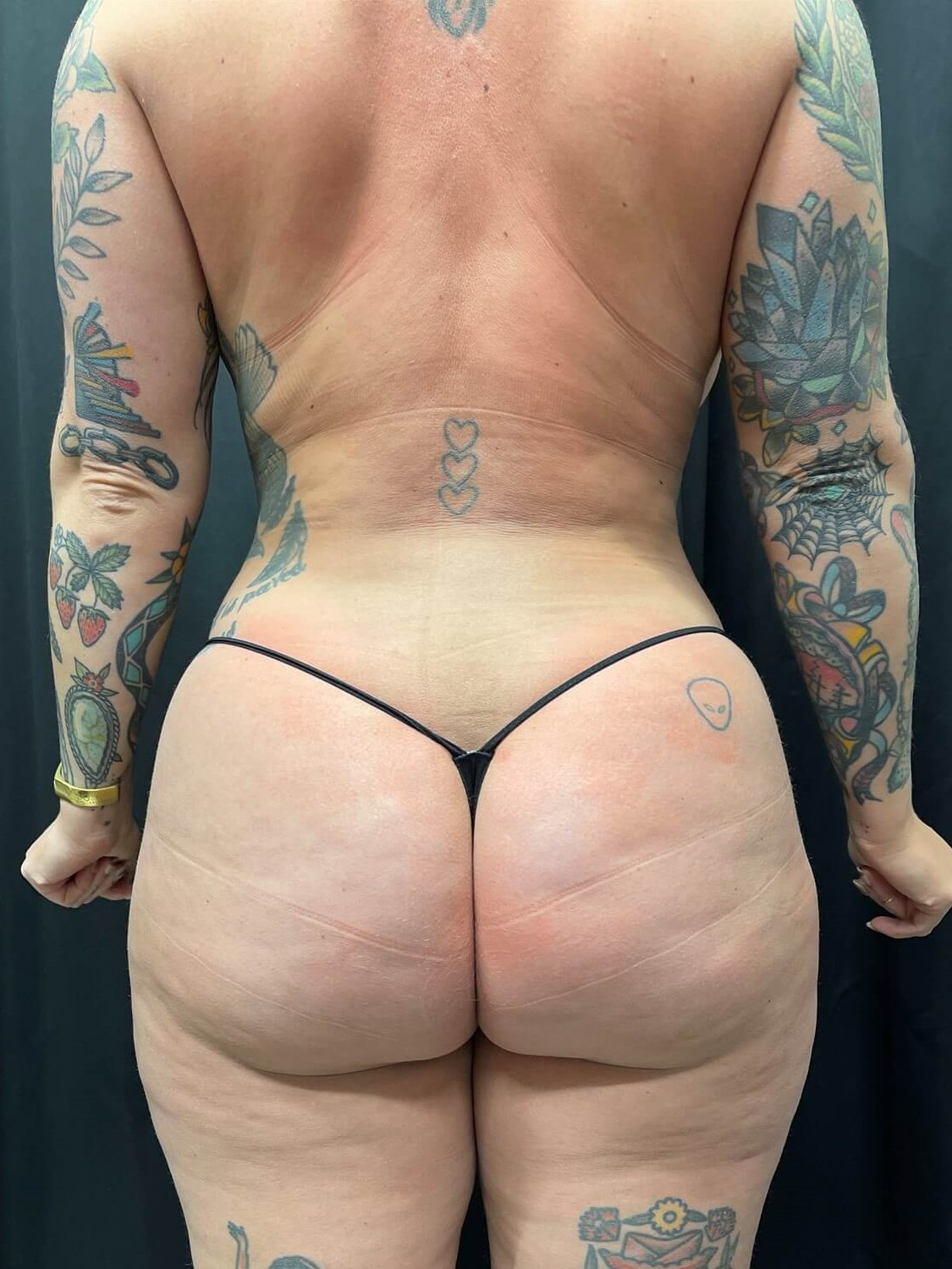 360 laser lipo back view After