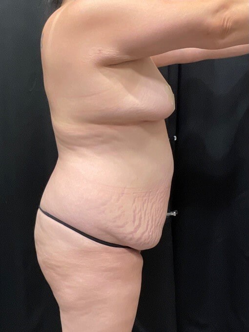 Mommy makeover Before