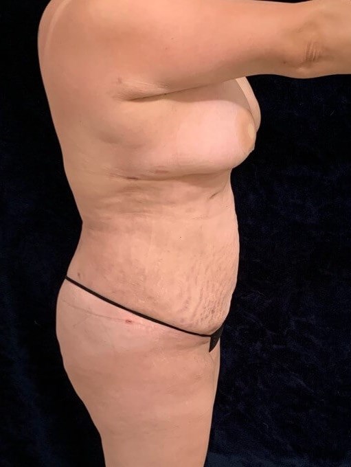 Mommy makeover After