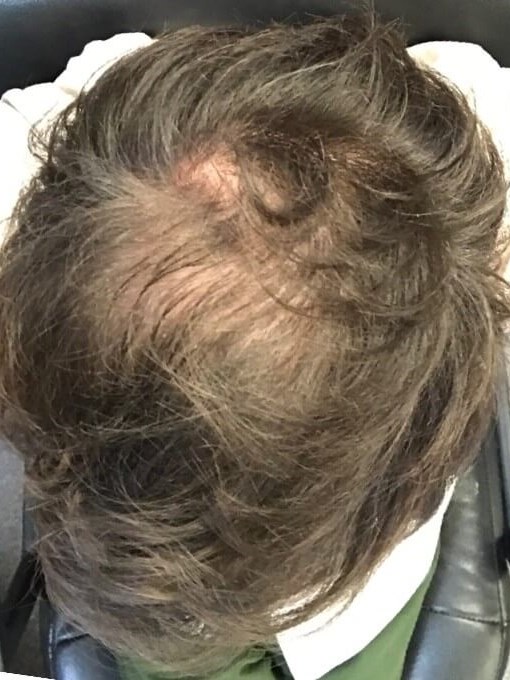PRP Hair Rejuvenation Before