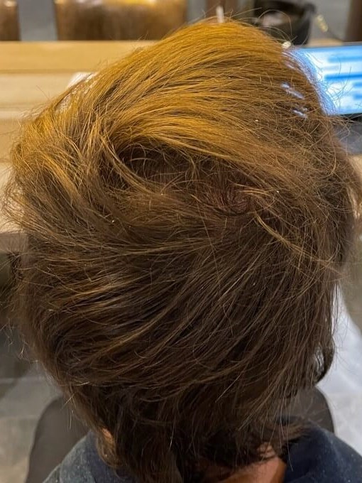 PRP Hair Rejuvenation After