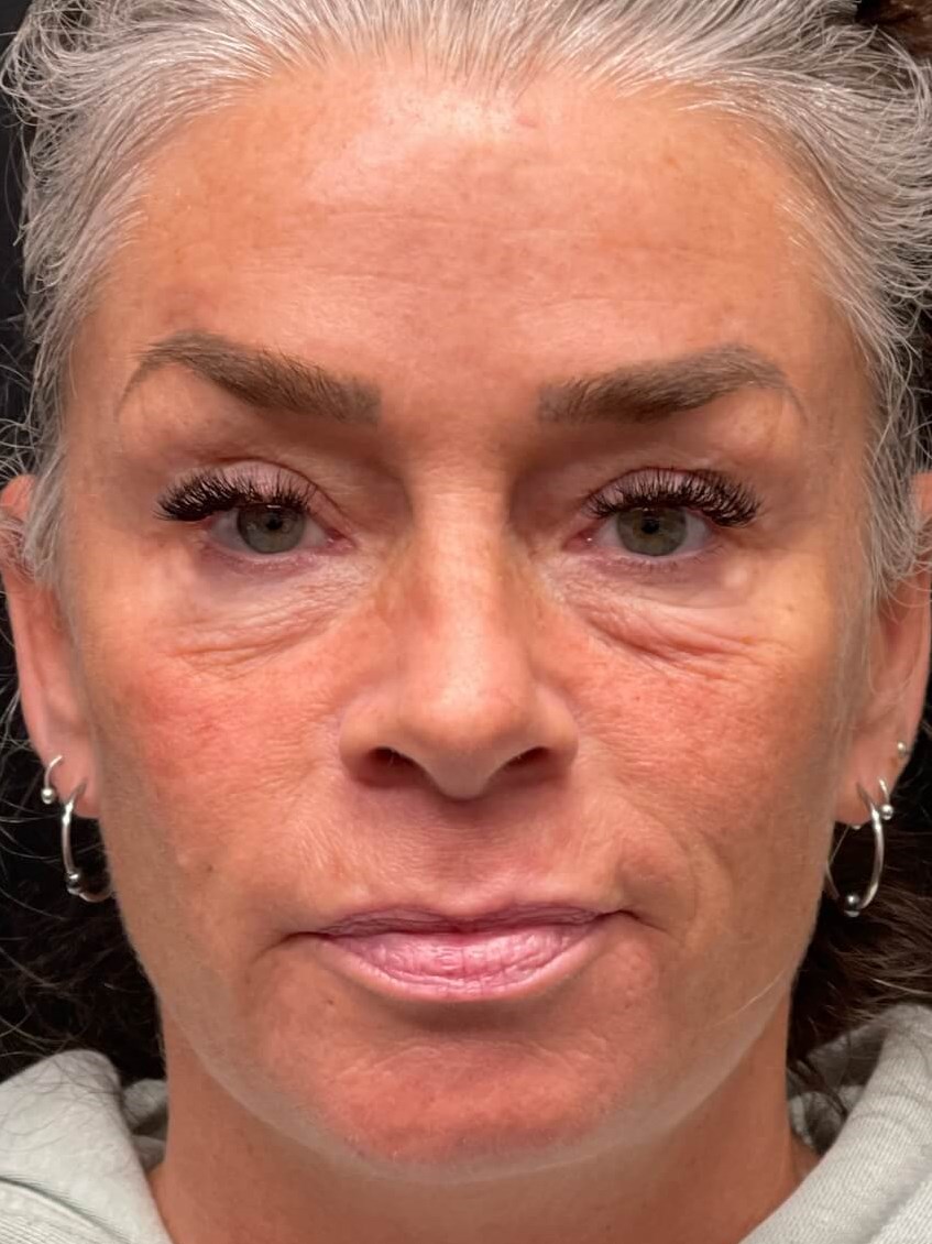 under eye and cheek filler Before