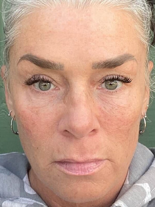 under eye and cheek filler After