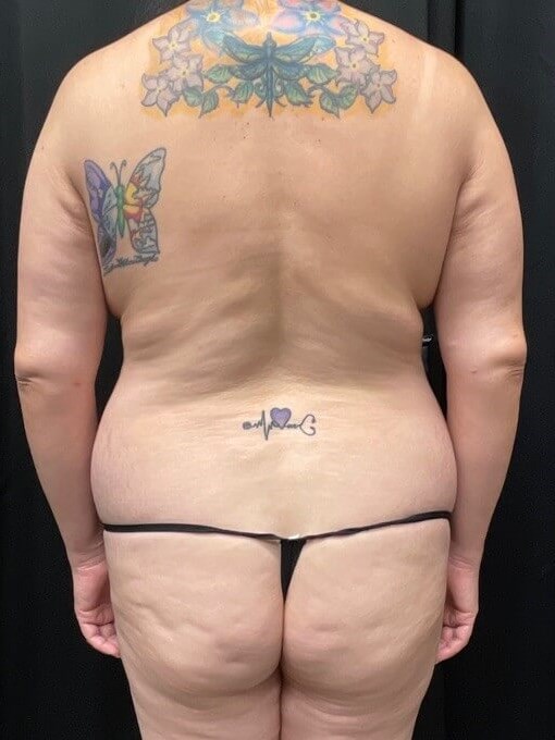 back view of 360 laser lipo Before