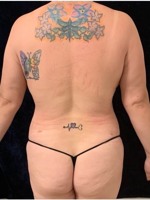 back view of 360 laser lipo After