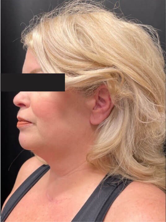 Chin, jawline and neck Before