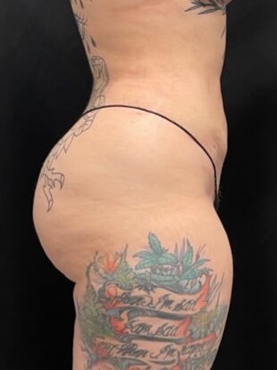 lower 360° liposuction After