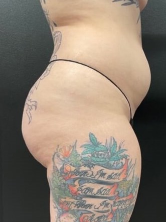 lower 360° liposuction Before