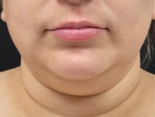 Chin and neck liposuction Before