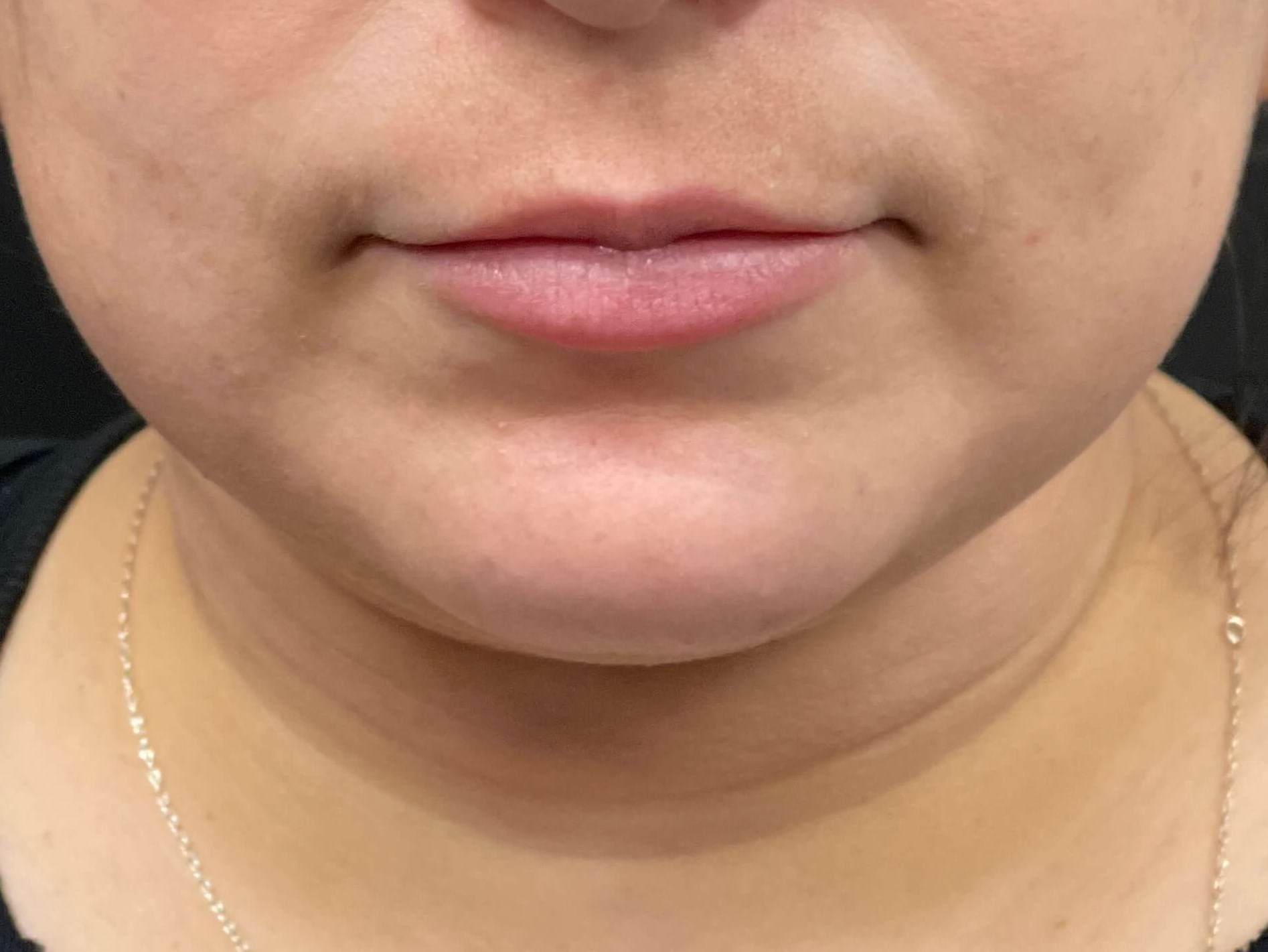 Chin and neck liposuction After