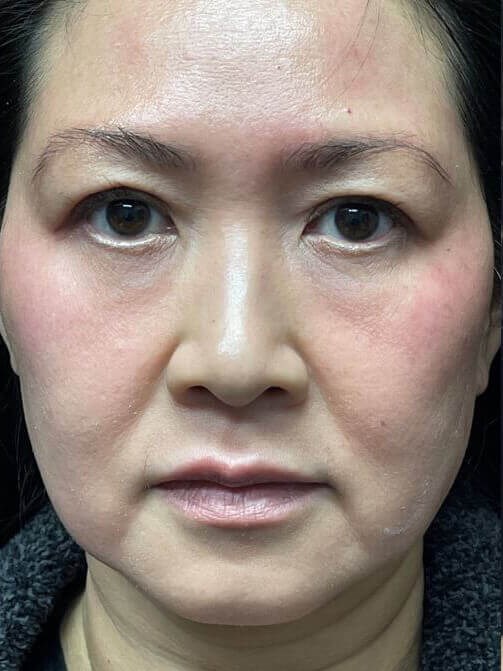 Fat as filler Before