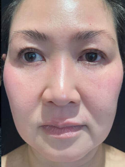 Fat as filler After
